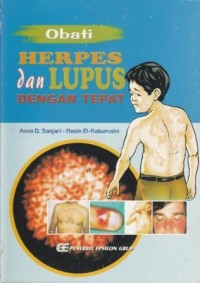 Obati herpes dan lupus dengan tepat